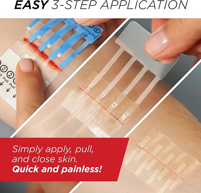 Clozex Emergency Laceration Closure & Kit FSA HSA Eligible Skin Closure Device Treat 5 Wounds Combined Up to 6 3/4" Includes Complete Kit to Clean, Close, & Cover Injuries Without Stitches